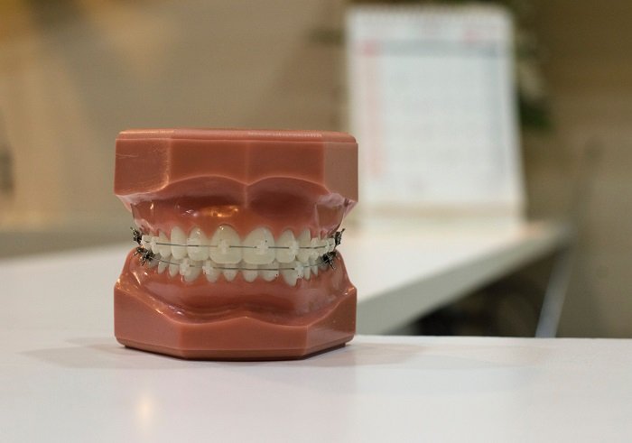 Modern Orthodontics: Less to Brace For