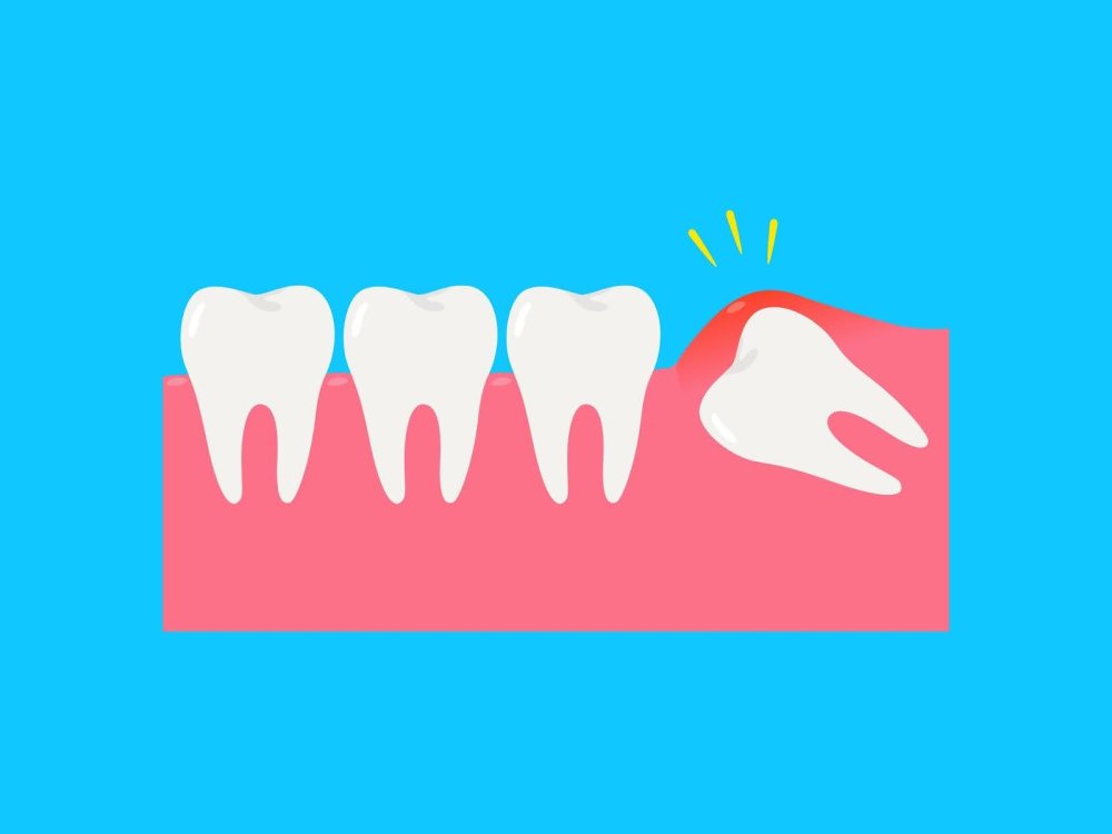 Facts About Wisdom Teeth: Myths, Truths, and What to Know